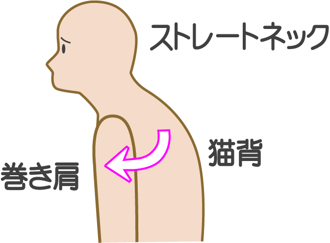 巻き肩・猫背・ストレートネックの関係を示したイラスト（鹿児島まどか整体院ブログ用）
