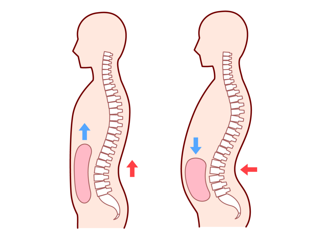 骨盤の前傾と後傾による姿勢と腹圧の変化を比較したイラスト。左は安定した姿勢、右は骨盤が傾き内臓が下がっている状態。