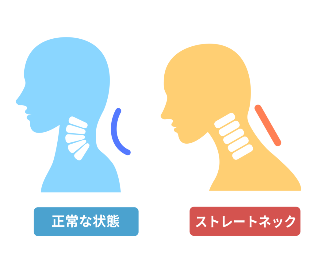ストレートネックと正常な頸椎の状態を比較した図。首のカーブが失われている様子が視覚的に示されている(まどか整体院ブログ用)