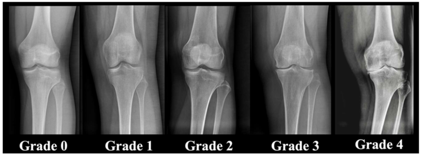 膝関節のレントゲン画像。ケルグレン・ローレンス分類に基づき、Grade 0(正常)からGrade 4(重度の変形性膝関節症)までの進行度を示している。