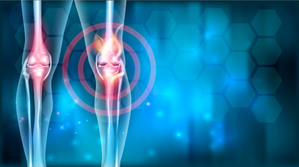 膝関節の炎症を示すイラスト。関節の痛みや変形性関節症をイメージしたビジュアル。鹿児島まどか整体院では、姿勢から関節の負担を軽減する整体をおこなっています。